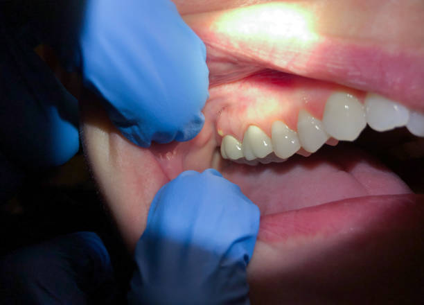 Best Emergency Dental Care for Abscessed Tooth in Long View, NC